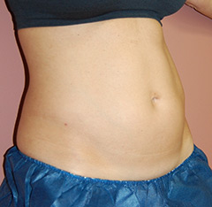 CoolSculpting® Non-Surgical Fat Reduction in Nashua, NH 1 Before & After