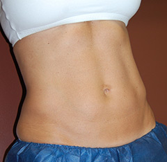 CoolSculpting® Non-Surgical Fat Reduction in Nashua, NH 2 Before & After