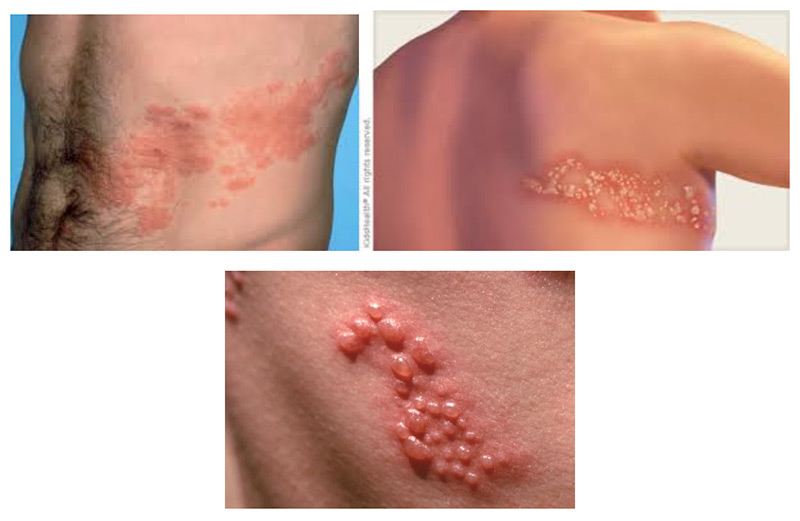 Rashes to know 1 rash1