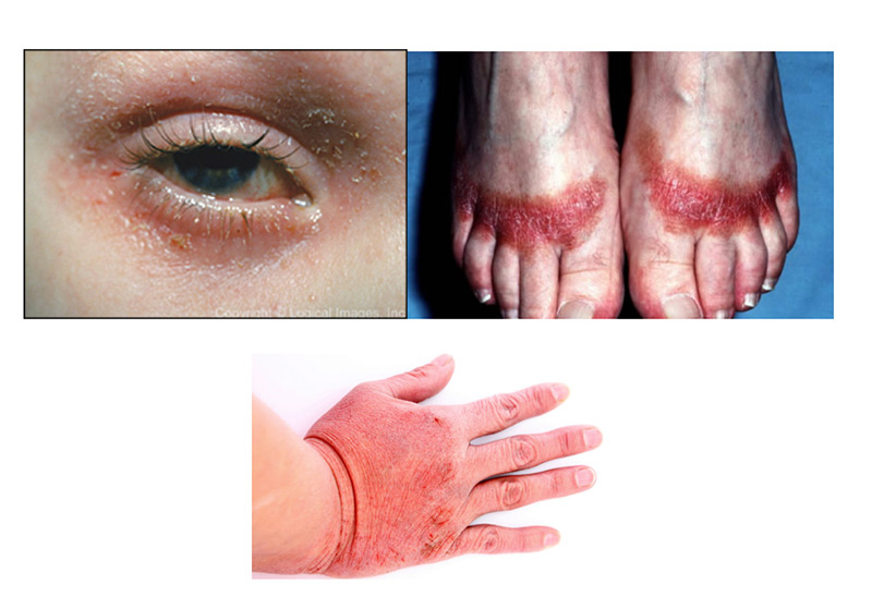 Rashes to know 2 rash3